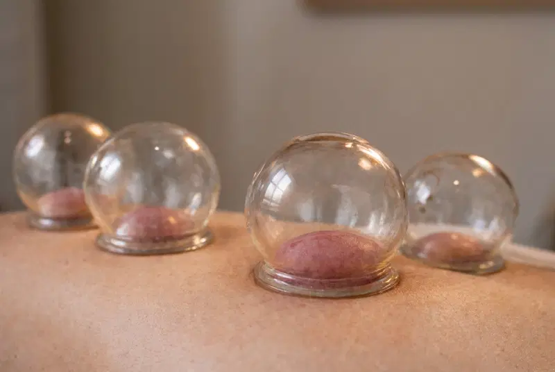 Cupping therapy at J.P. Hou Institute Orlando & Altamonte Springs